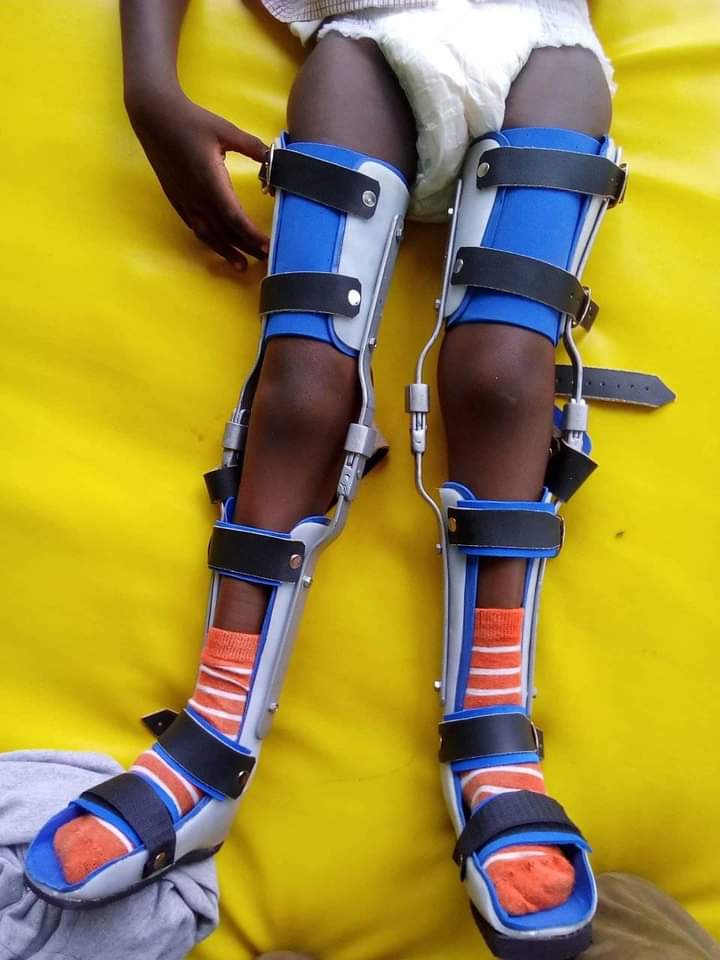 Orthotics Services at Nkolo Orthopaedics Rehabilitation Center (NORC)