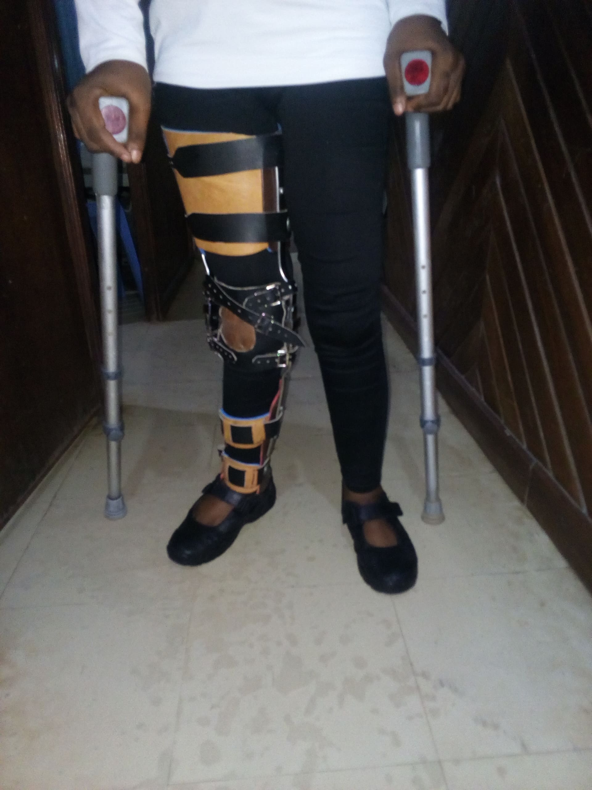 Orthotics Services at Nkolo Orthopaedics Rehabilitation Center (NORC)