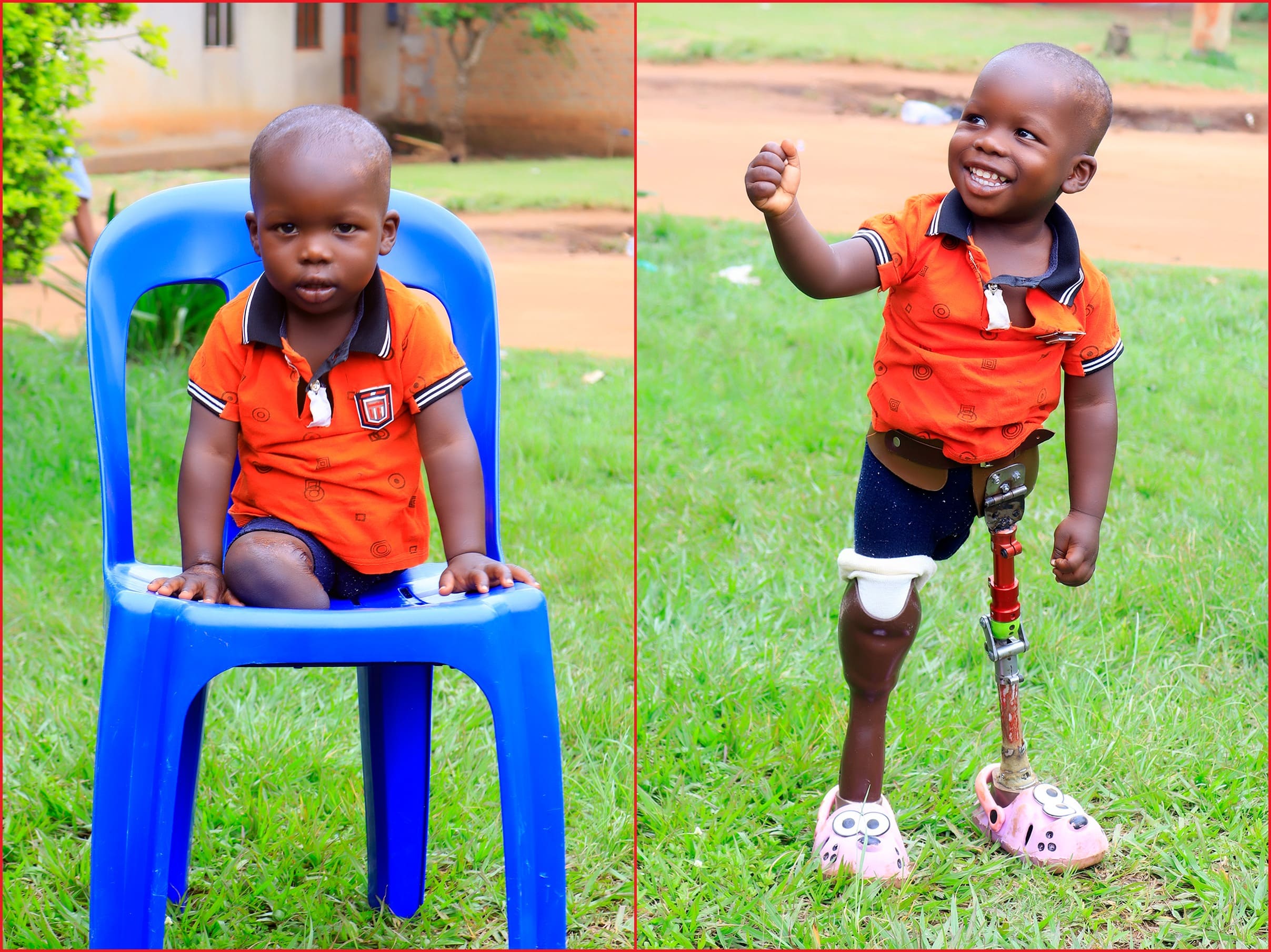 Before & After getting prosthetic limbs (legs) from Nkolo Orthopaedics Rehabilitation Center (NORC)