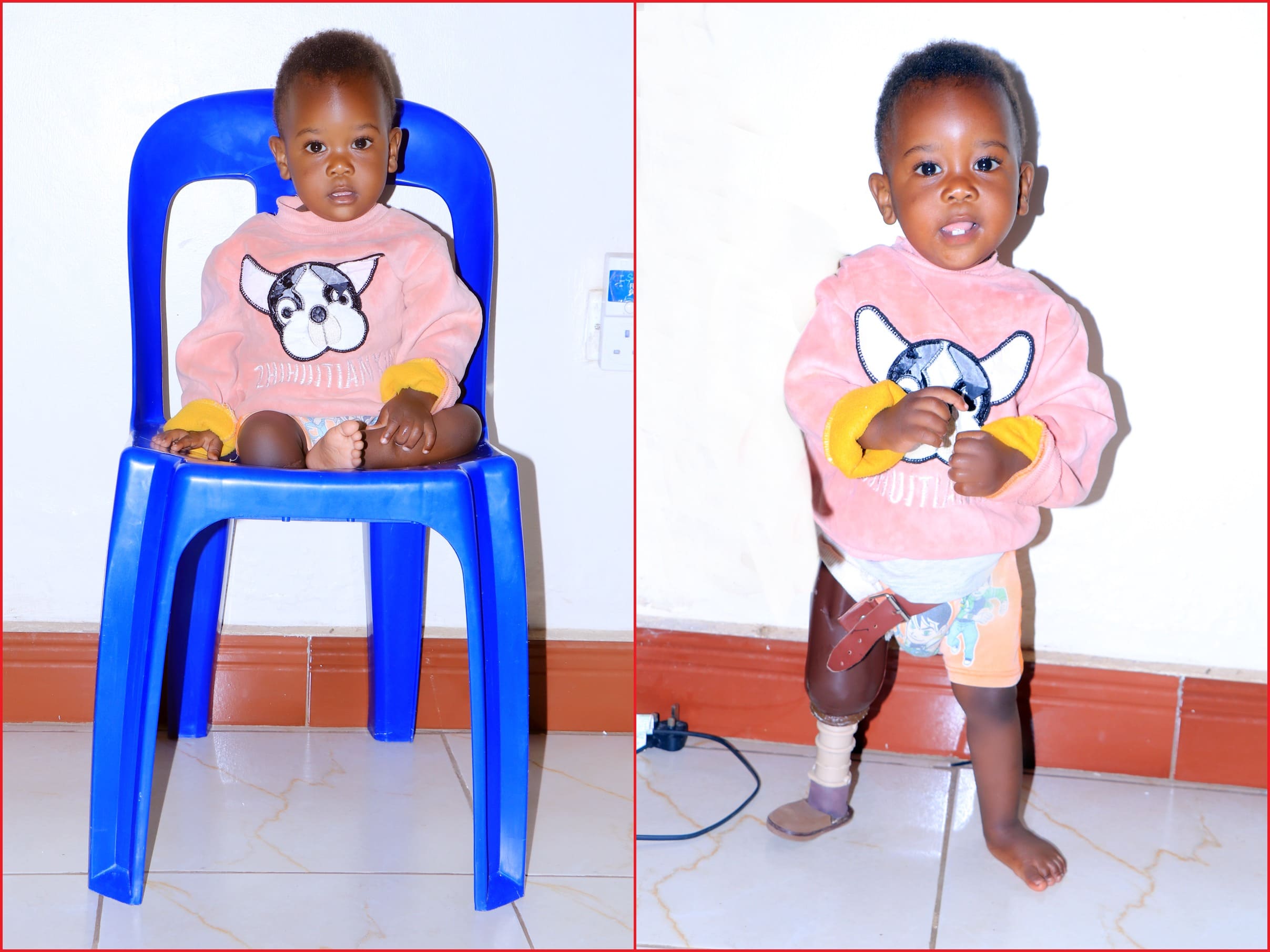 Before & After getting prosthetic limbs (legs) from Nkolo Orthopaedics Rehabilitation Center (NORC)