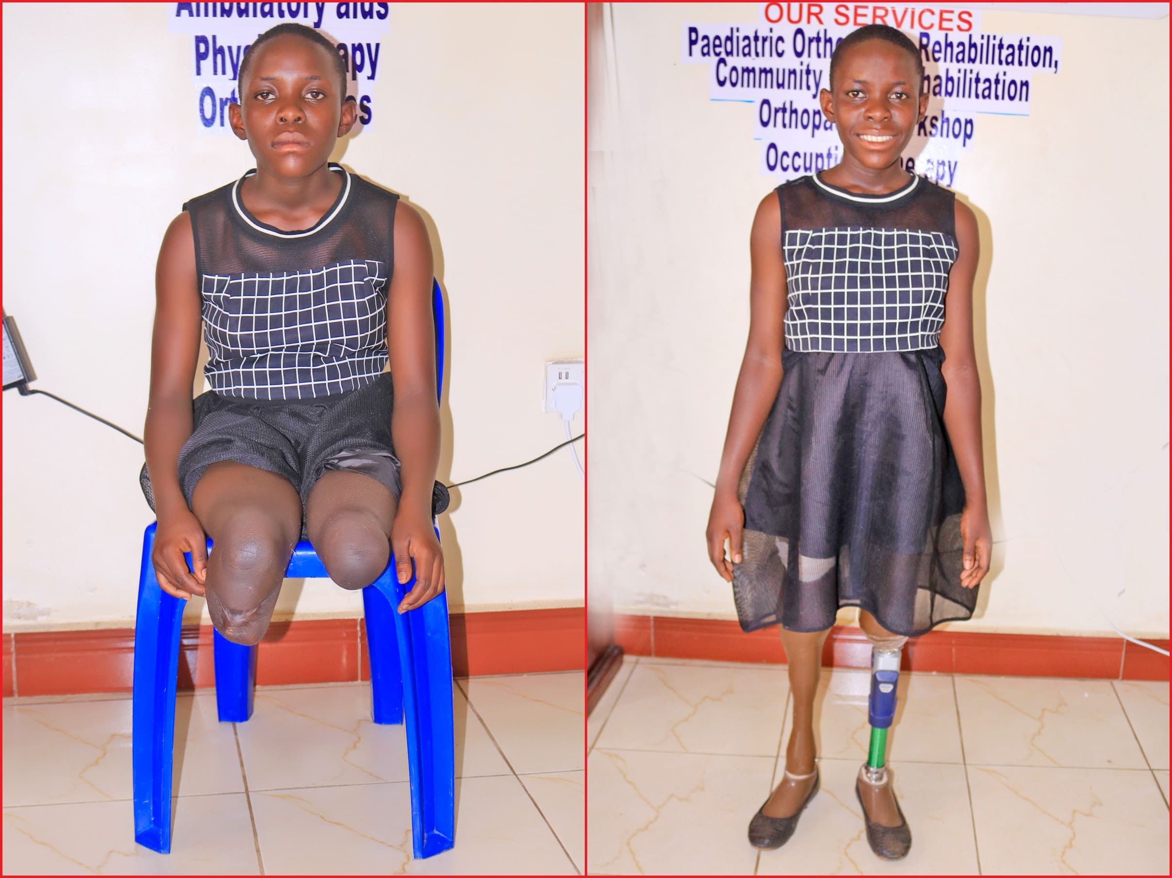 Before & After getting prosthetic limbs (legs) from Nkolo Orthopaedics Rehabilitation Center (NORC)