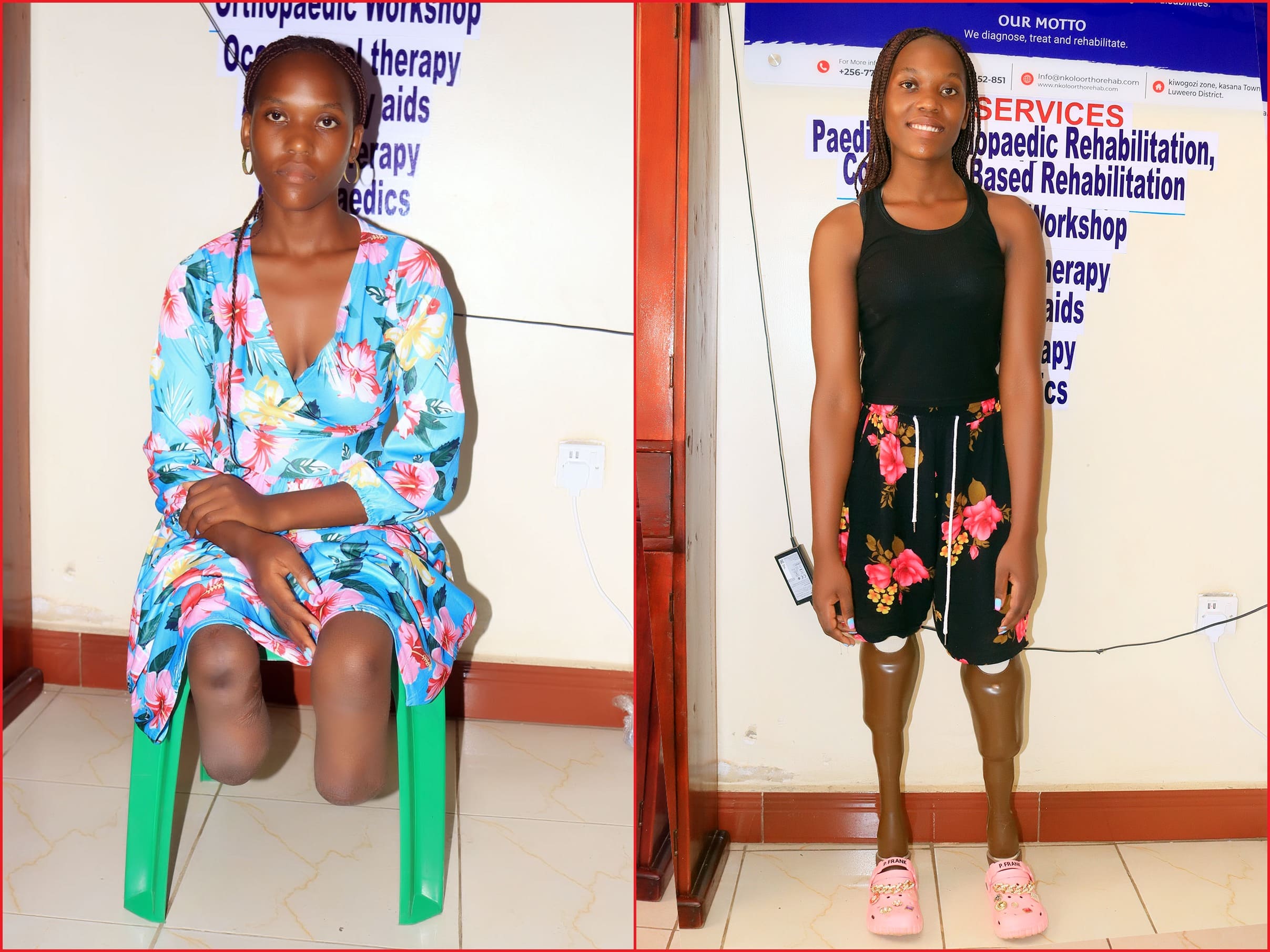 Before & After getting prosthetic limbs (legs) from Nkolo Orthopaedics Rehabilitation Center (NORC)